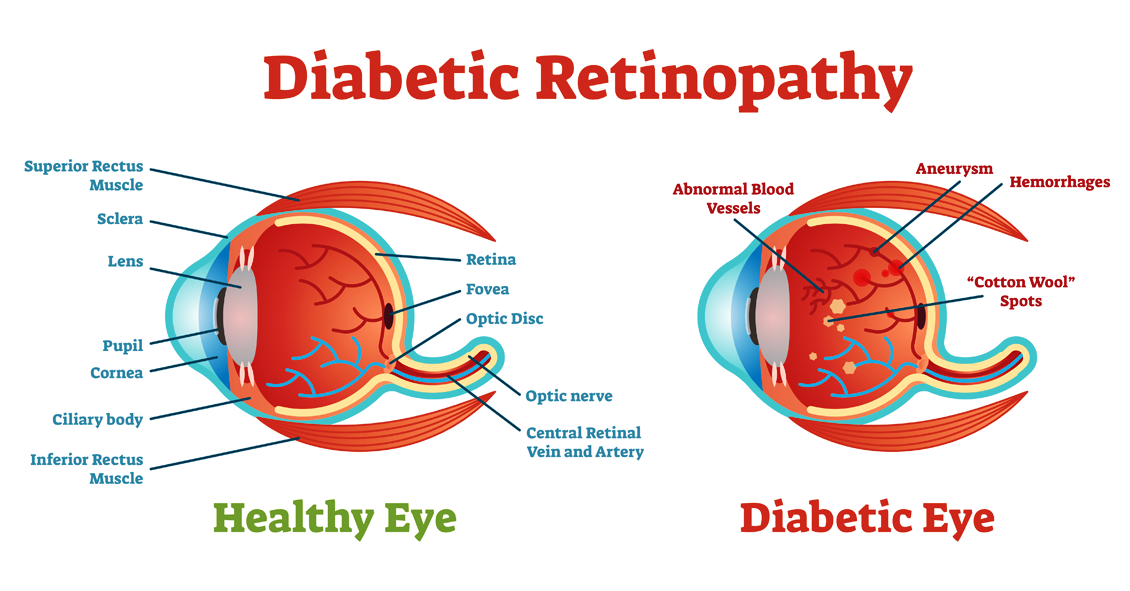 What Is a Detached Retina? - Outlook Eyecare